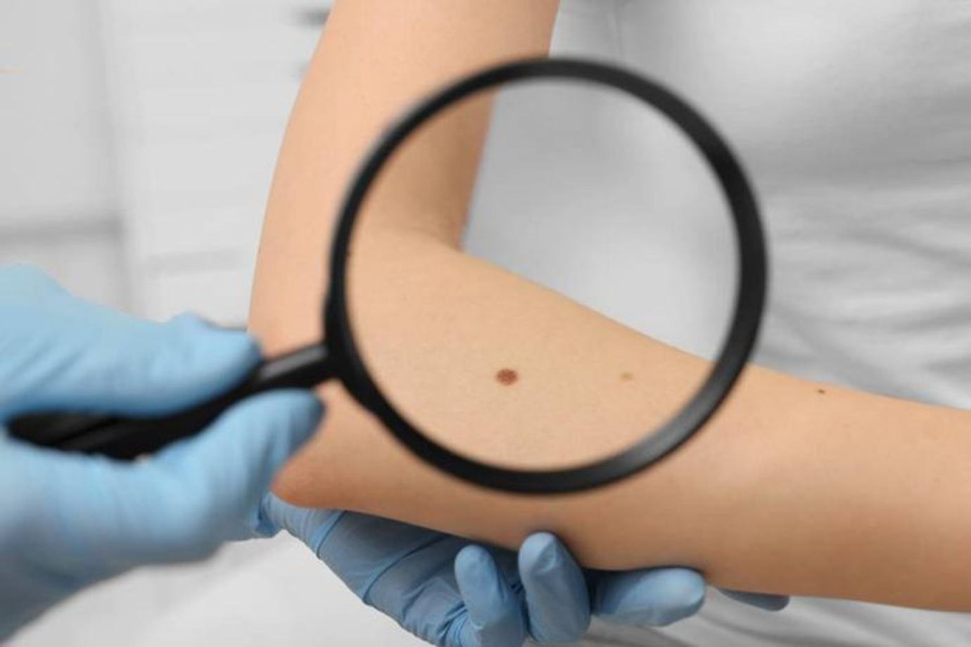 Día Mundial del Cáncer de Piel: cuidá tu piel, protegé tu salud